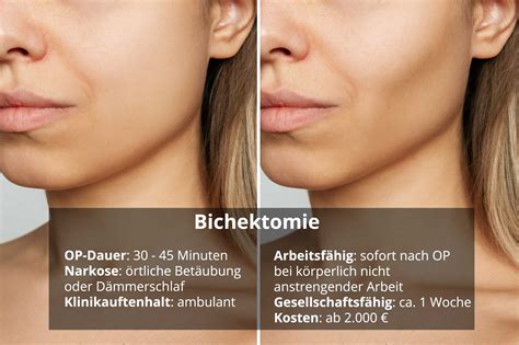buccal fat removal kosten