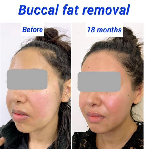 buccal fat removal london