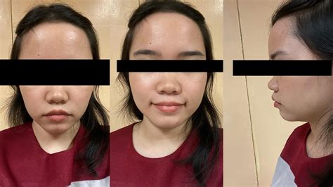 buccal fat removal looks terrible reddit