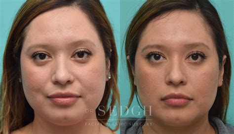 buccal fat removal los angeles