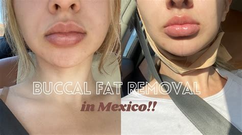 buccal fat removal mexico