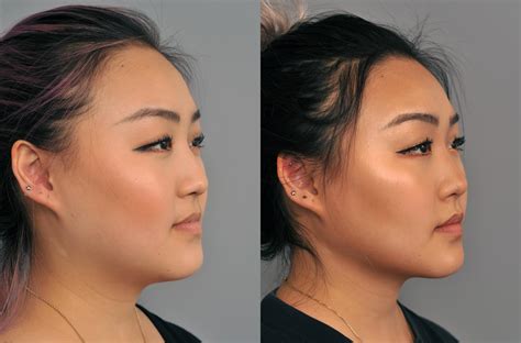 buccal fat removal on groupon in seattle