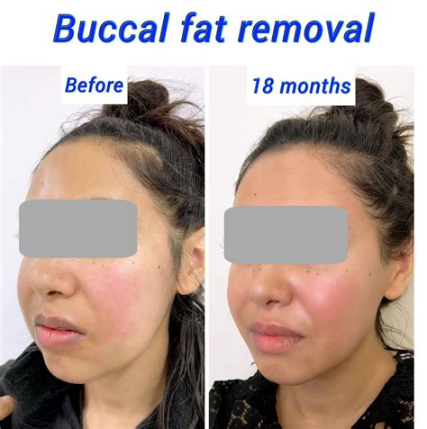 buccal fat removal recovery time