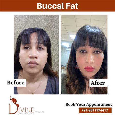 buccal fat removal surgery cost in india