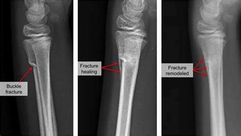 Buckle Fracture Vs Fracture