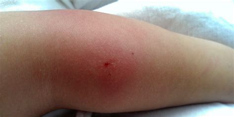 Bug Bite Swollen Hot: Causes, Symptoms, and Effective Relief