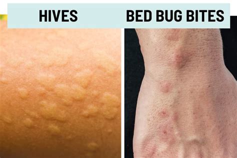 bugs that cause hives