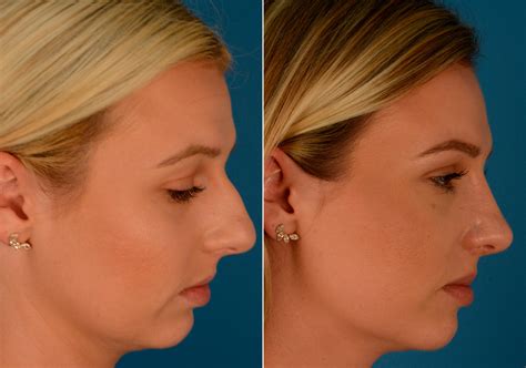 rhinoplasty before after bulbous Nose fillers, Nose job, Nose surgery