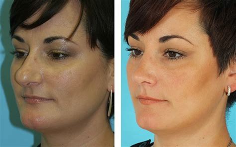 Bulbous Nose Rhinoplasty Before And After Images Rhinoplasty before