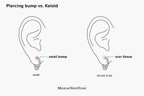 bump on earlobe next to piercing
