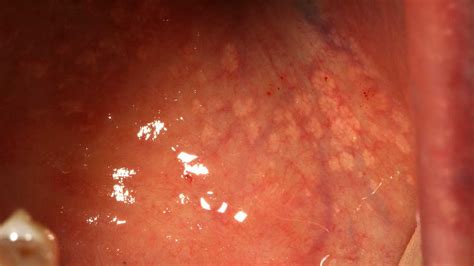 Understanding and Addressing a Bump on Labia Lip: Causes, Symptoms, and Treatment Options