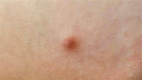 bump on side of stomach