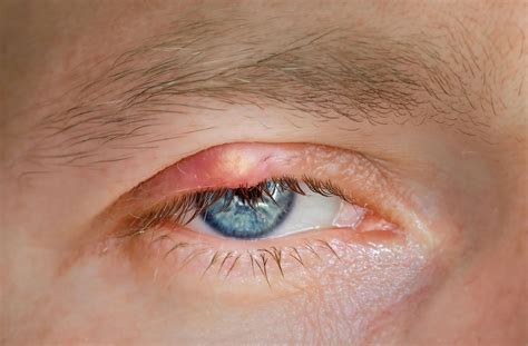 What Causes a Bump on Upper Eyelid?