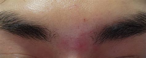 Bumps After Shaving Eyebrows