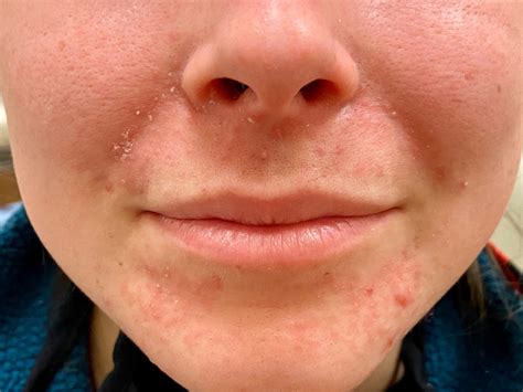 What Are Those Bumps Around Your Mouth? Causes and Treatments Explained