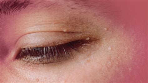 What Are Those Bumps on Eyelid? Causes, Symptoms, and Effective Treatments