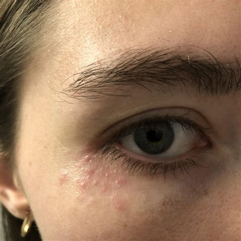 Bumps Under Eye