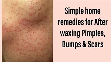 How to Get Rid of Bumps after Waxing Perfect skin care routine, Clear