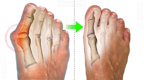 How to Get Rid of Bunions Without Surgery? Get rid of bunions, Bunion