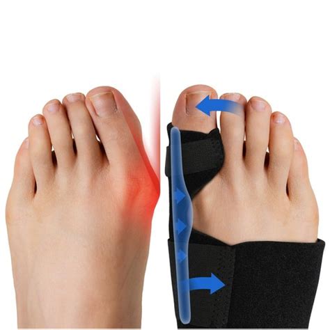Bunion Corrector Fsa Eligible