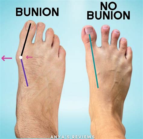 Bunion On Foot