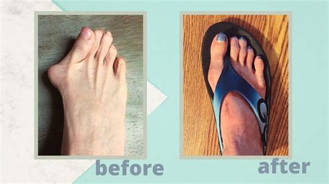 Bunion Surgery Effectiveness