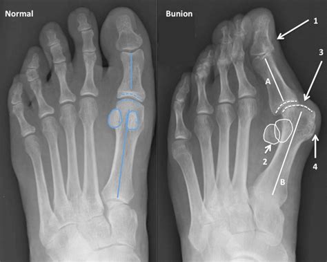 Bunion X-Ray Guide: Unveiling the Hidden Truths Behind Your Foot Pain