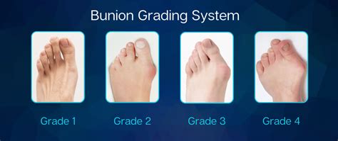 Bunions