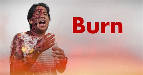 burn