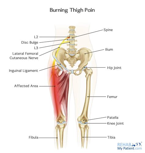 Understanding and Relieving the Burning Feeling in Thigh: Causes and Solutions