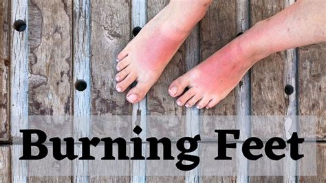 Burning Feet With Exercise