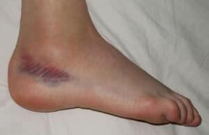 Bursing Prevention and Treatment Guide