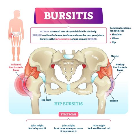 Understanding and Managing Bursitis in Hip: Causes, Symptoms, and Effective Treatments