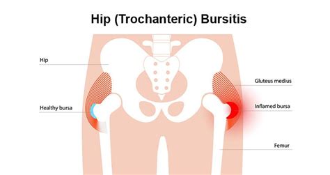 Understanding Bursitis in the Hip: Causes and Effective Treatments