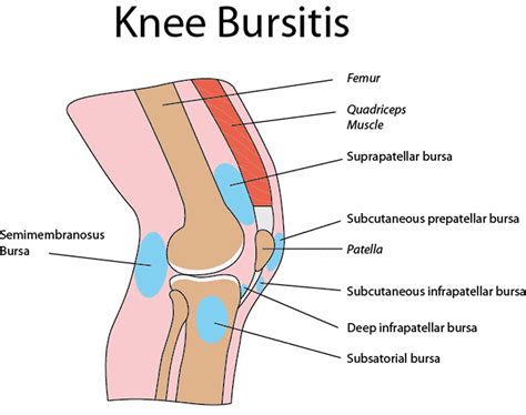 Understanding and Managing Bursitis of Knee Effectively