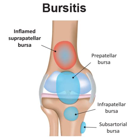 Understanding and Managing Bursitis of the Knee: Causes, Symptoms, and Effective Treatments