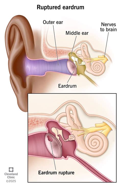 Burst Middle Eardrum