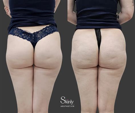 butt filler before and after