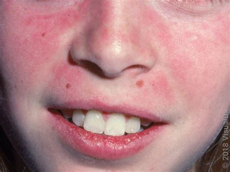 Butterfly Face Allergy