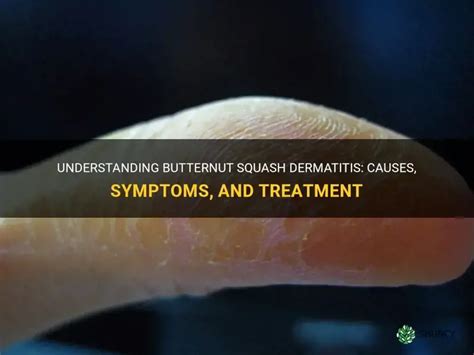 Butternut Squash Dermatitis