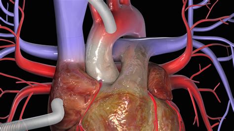 Understanding Bypass Surgery Heart: Risks, Benefits, and Recovery Insights