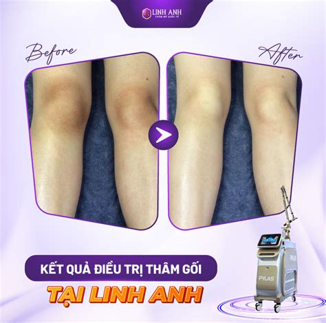 cách trị thâm đầu gối