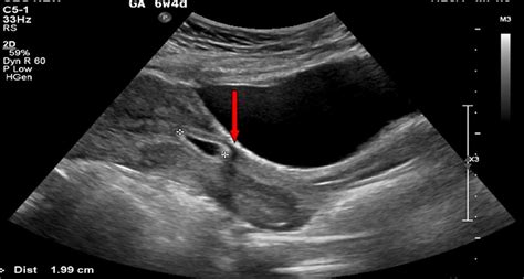 c section scar endometrioma ultrasound