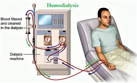 c. auris and dialysis