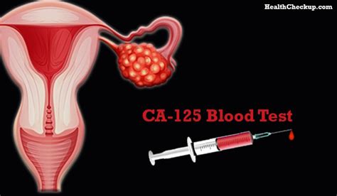 ca 125 blood test for cancer