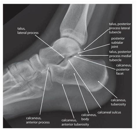 Calcaneal Xray Labeled