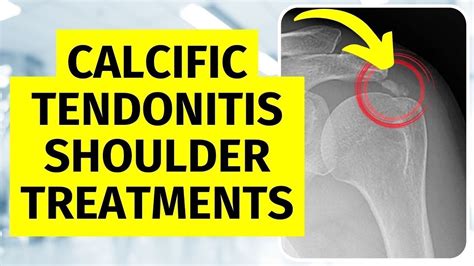 enPuls Calcific tendinitis of the shoulder YouTube