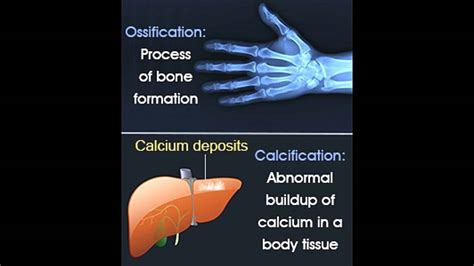 calcification vs ossification bone