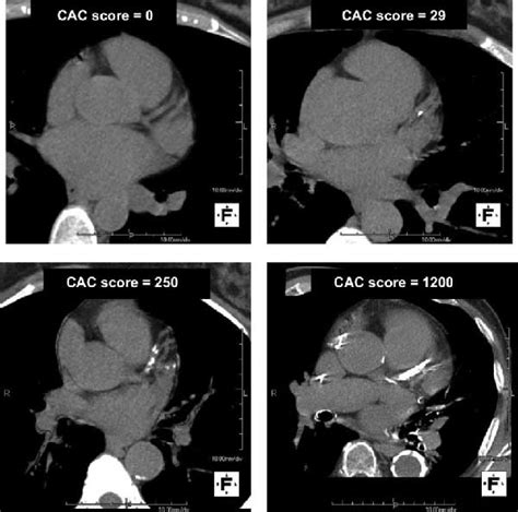 Unlocking Heart Health: What Does Your Calcium Score Heart Scan Reveal?