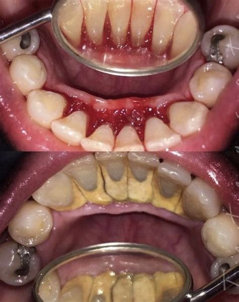 calculus teeth removal
